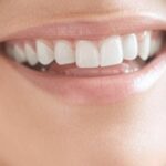 Faccette dentali, il trend estetico del momento per un sorriso dalla bellezza naturale