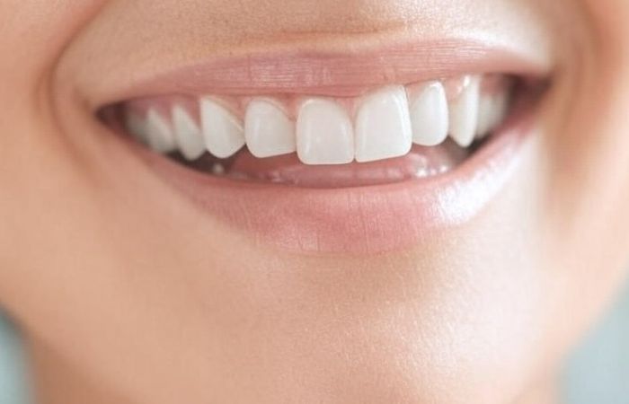Faccette dentali, il trend estetico del momento per un sorriso dalla bellezza naturale
